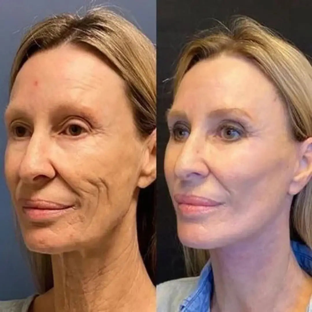 SkinLift™ | Botox Serum | “93% yngre hud på 14 dagar – bevisat av Glow Science Lab™.