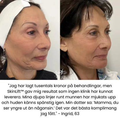 SkinLift™ | Botox Serum | “93% yngre hud på 14 dagar – bevisat av Glow Science Lab™.