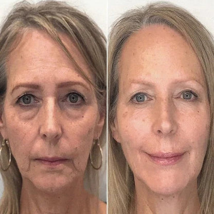 SkinLift™ | Botox Serum | “93% yngre hud på 14 dagar – bevisat av Glow Science Lab™.
